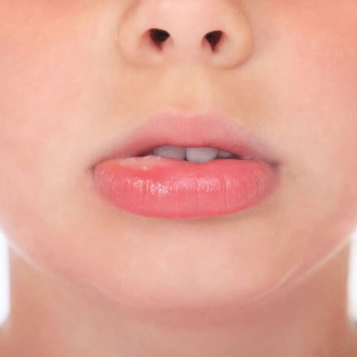 Что делать, если ребенок <br>всё-таки прикусил щеку или губу